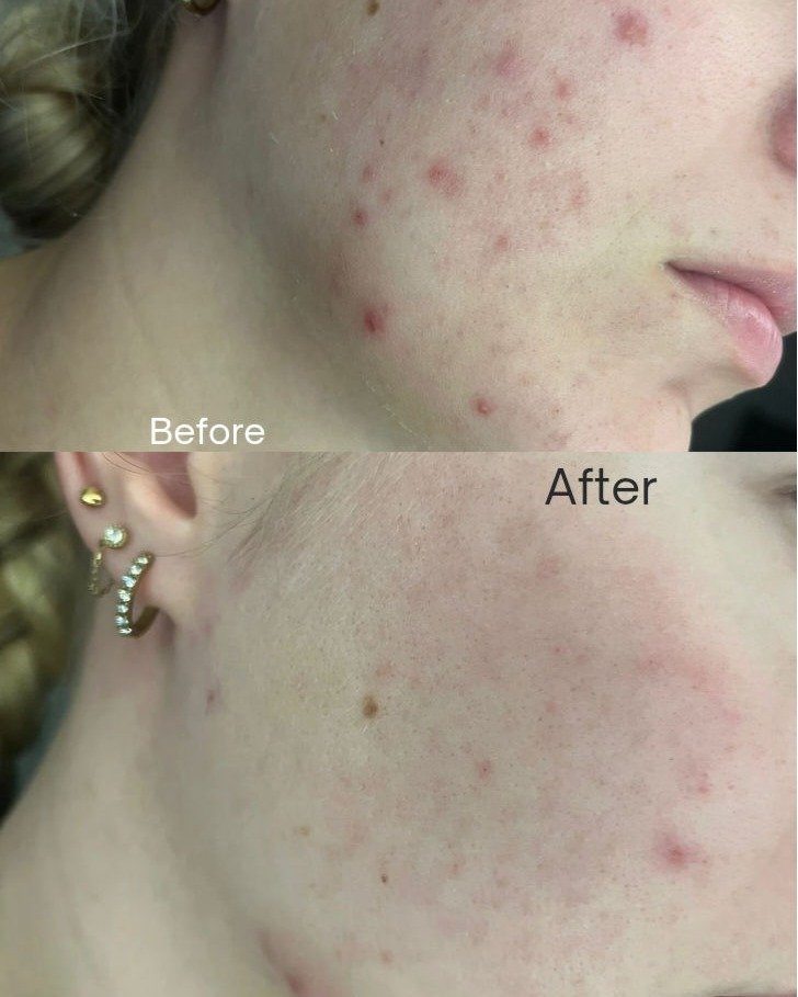 Green Peel behandeling — voor en na resultaat
